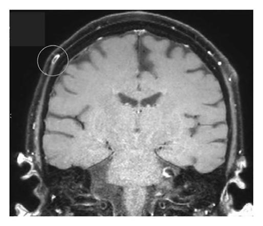 Neurologická zobrazovací vyšetření u očních onemocnění Chwalisz a spol. postihující další hlavové nervy nebo mozek se vyskytuje vzácně.