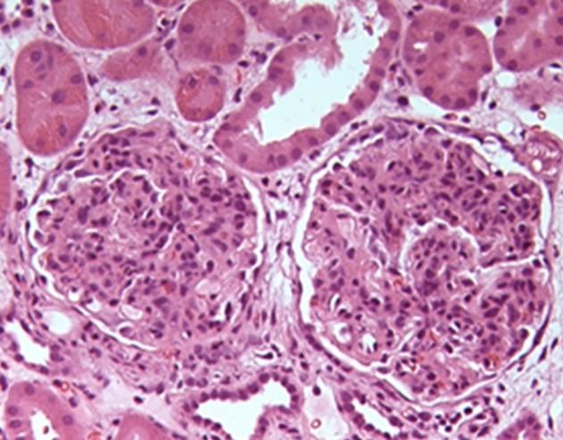Akutní glomerulonefritis Difusní zánětlivá buněčná infiltrace a mesangiální