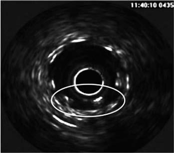 Obr. 1. IVUS. Nedostatečná apozice stentu. V lumen je patrný artefakt IVUS sondy. V kroužku jsou zvýrazněny vzpěry stentu, které nedoléhají k intimě Obr. 2. IVUS. Modrou linií je zvýrazněn stent a zelenou linií je naznačena velikost tepny.