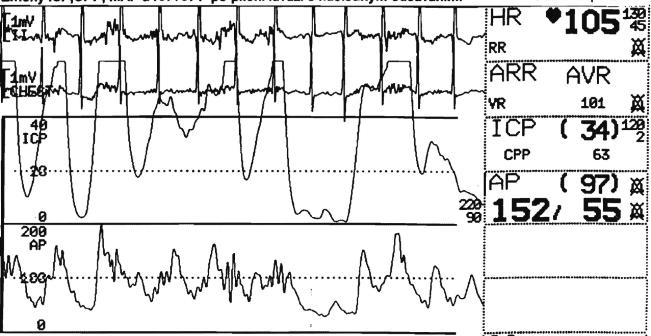 EKG Abnormální ást EKG k ivky Puls [tep/min] #1 [mmhg] Arteriální tlak [mmhg] ová stoupá Systolický arteriální tlak stoupá stoupá až na 60mmHg je ne Intakraniální tlak má lepší hodnoty než v dob #1 a