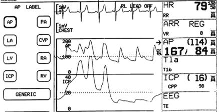 EKG Puls [tep/min] Arteriální tlak [mmhg] #1 [mmhg] ová Arteriální tlak stoupá stoupá až na 60mmHg stoupá Arteriální tlak má lepší hodnoty než v dob Intakraniální tlak má lepší hodnoty než v dob je