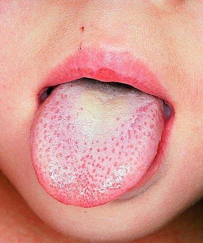 Tonzilofaryngitida (sore throat) adenoviry (často i spojivky -- faryngokonjunktivální horečka) EBV (součástí infekční mononukleózy) S. pyogenes streptokoky sk. C, G Arcanobacterium heamolyticum N.