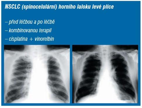 kosmogenní dědičnost datování psoriáza z roku irsko