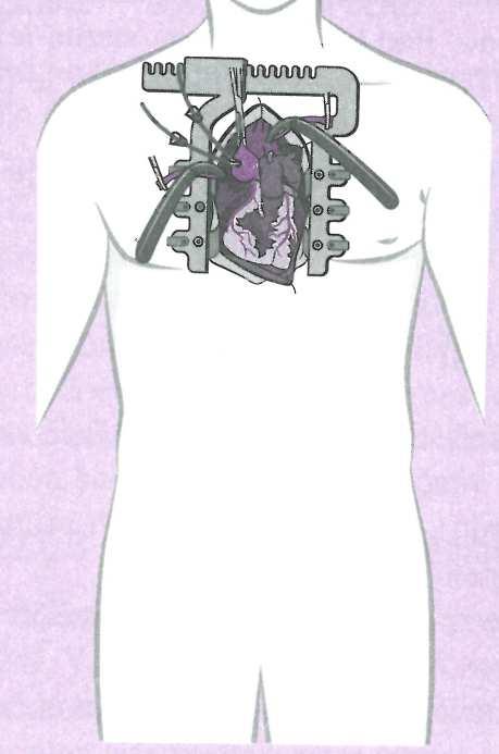 1.4 Mediánní sternotomie Mediánní (střední) sternotomie je nejčastějším přístupem k srdci a všem srdečním operacím.