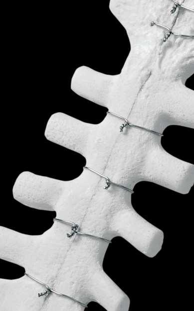 2 Druhy spojení hrudního koše Pevné spojení může být provedeno několika následujícími způsoby, kdy je rozříznutý hrudní koš v místě hrudní kosti pevně fixován.