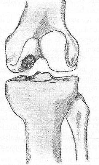 fragmentu nekrotické kosti od okolní kosti (vzniká disekát). Později pak dochází k degenerativním změnám nad ním ležící kloubní chrupavky a k jejímu odtržení.