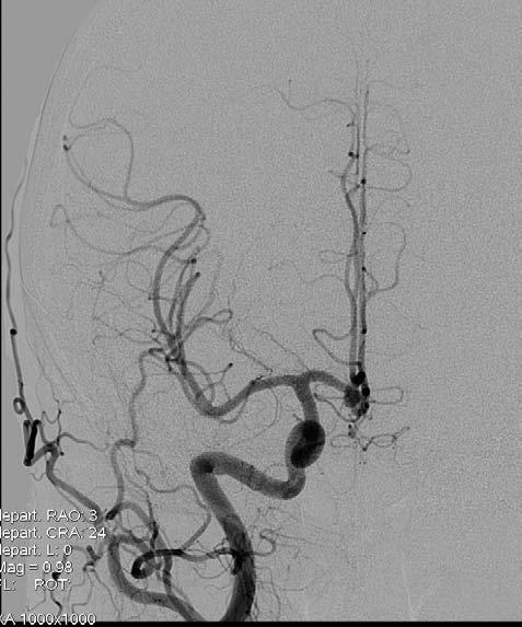 pharyngeus ACA ACM A 1 A 2 a. ophtalmica ACM sifon ACI DSA ACI bočná projekce Obr. 1.11 Normální angiogram větve ACI: a.