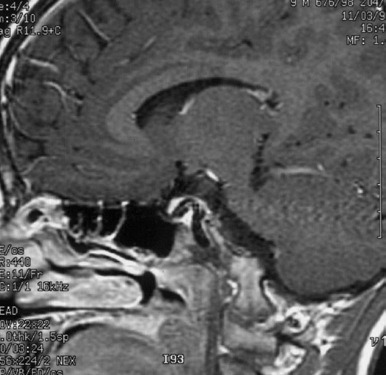 Rinitidy, sinusitidy a nosní polypy LOBUS FRONTALIS THALAMUS MES PONS E S ACI MT B IT C1 DA CEREBELLUM HP C2 TONGUE C3 T1 W postkontrastní MR obraz parasagitální rovina Obr. 1.