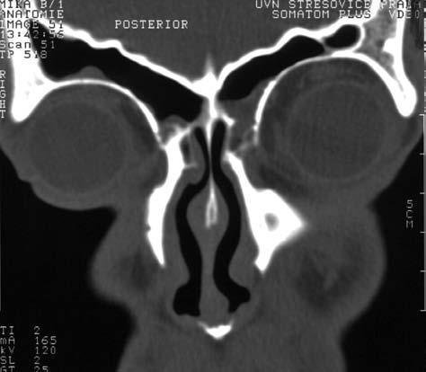Anatomie FS E AN LPM EA CP L O M AN FP LS MT CT koronární rovina snímek je mírně rotován vlevo dopředu Obr. 1.35 Velké čelní dutiny.
