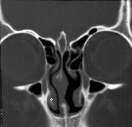 Rinitidy, sinusitidy a nosní polypy CG LO CP E CG SR MT LS + M M B MT IT CT koronární rovina přední etmoidy, snímek je rotován vpravo dopředu CT koronární rovina Obr. 1.