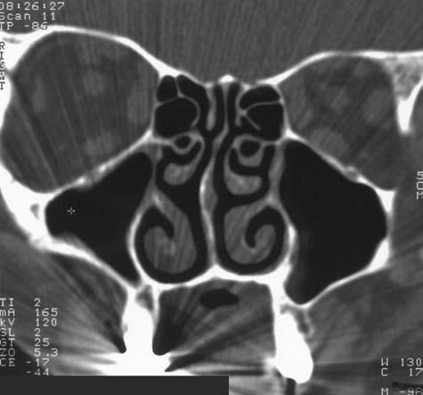 Rinitidy, sinusitidy a nosní polypy sinus frontalis (reces. supra or bi ta lis) ala major ossis sphe no i da lis n.