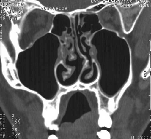 Anatomie II E ST MT ST V2 IOF TEM Z MA PH T A CT koronární rovina v úrovni zadních etmoidů LF E V2 IOF TEM Z PH MA T BM B T1 W MR obraz koronární rovina Obr. 1.50 A, B Zadní čichové sklepy (E), n.