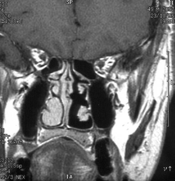 Rinitidy, sinusitidy a nosní polypy LW MCF SOF GW II E ITF IOF V2 MD MA A CT koronární rovina E B T1 W MR obraz koronární rovina Obr. 1.51 A, B Zadní etmoidy (E) Obr.