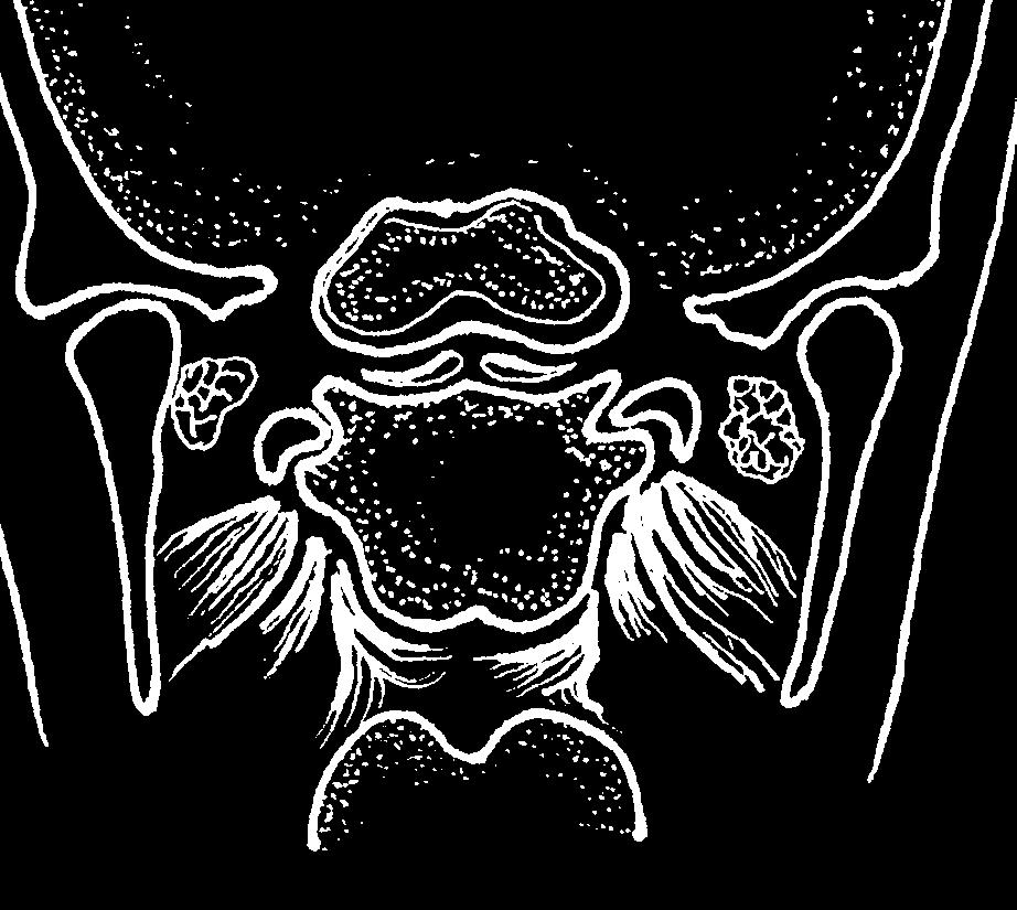 Anatomie facies temporalis alae majoris canalis opticus ala minor crista sphenoidalis apertura sinus sphenoidalis margo parietalis margo zygomaticus fi ssura