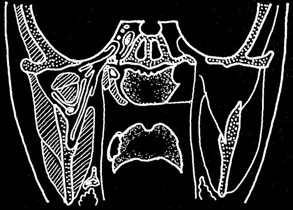 Rinitidy, sinusitidy a nosní polypy m. tem po ra lis n. mandibularis tuba Eustachi n.v ACI hypophysis fossa cranii media sinus cavernosus S GW fossa temporalis m.