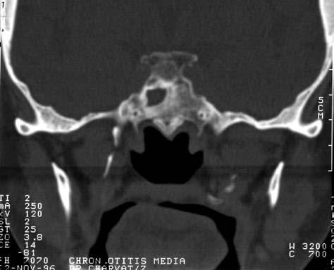 Anatomie putamen capsula externa capsula extrema claustrum cisterna chiasmatica os temporale n. III, IV, VI glandula pituitaria sinus sphenoid.