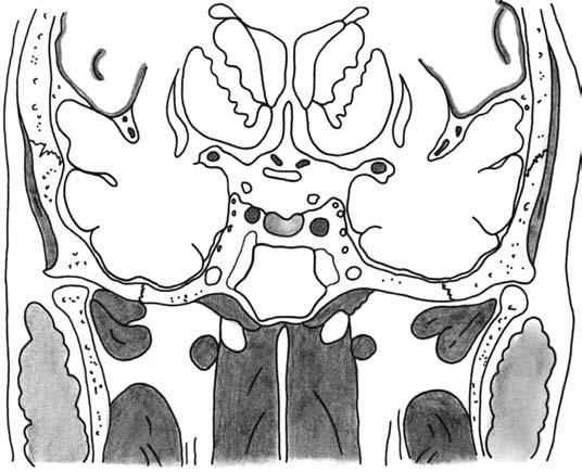 ACI sinus cavernosus gyrus occipitotemporalis lat. ganglion trigemini m. pterygoideus lateralis m. levator veli palatini ramus mandibulae glandula parotis m. pterygoideus med. Obr.