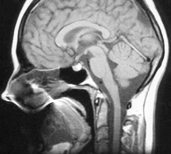 B: čelní mozkový lalok (LF), baze přední jámy lební (šip ka dolů), čichové sklepy (E), horní (ST), střední (MT) a dolní (IT) skoře