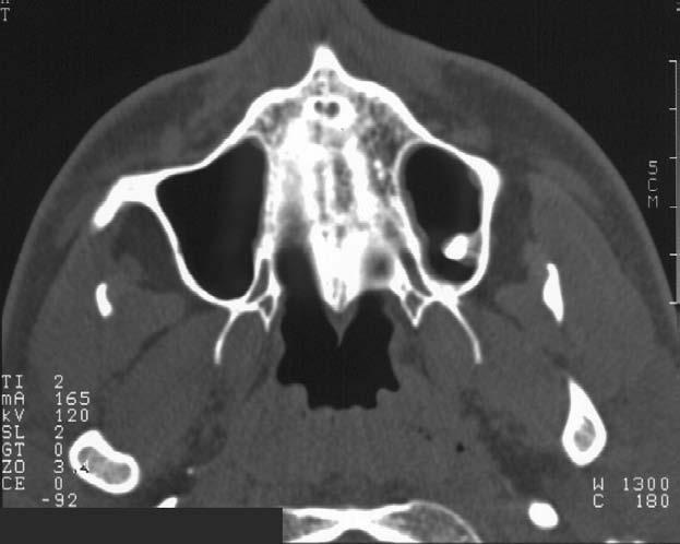 Alveolární výběžek čelistní dutiny (M), tukový polštář tváře (černá *), mandibula (MD), n. et vasa alveolaris mandibulae (AM). M.