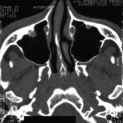 Anatomie NL MT PPF LP MP CL A CT axiální rovina Obr. 1.81 A, B Deviace nosního septa, dolní část střední lastury (MT), slzný kanálek (NL).