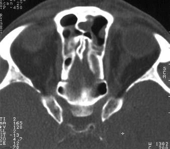 B: nazofrontální duktus (FS), etmoidy (E), jařmová kost (Z), frontální lalok (FL) B T1 W MR obraz axiální