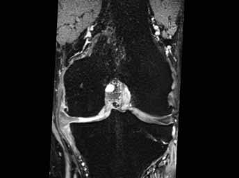 3 defekt a patologické změny mohou dosahovat až ke kosti stupeň 4 poškození chrupavky v celé její šíři, odhalená subchondrální kost, subchondrální změny v kostní dřeni Obr. 2.