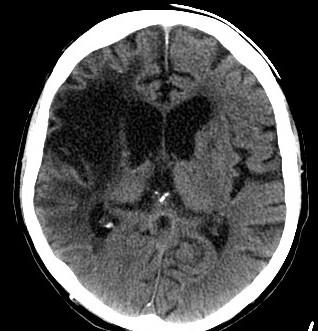 dense artery sign = trombus/uzávěr tepny zobrazující se jako hyperdenzní