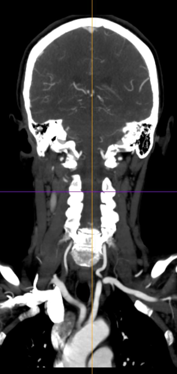 CT angiografie CTA I. II. III.