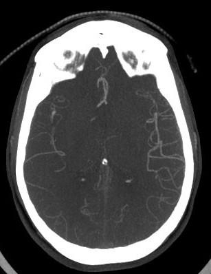 angiografie (skenování ve třech fázích s odstupem