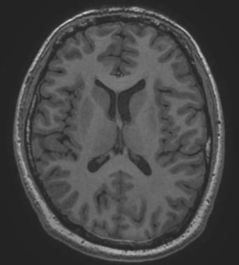 MR základní sekvence T1 vážený obraz (T1WI) T2 vážený obraz (T2WI) Proton Density (PD) krátký TR (<1000ms) krátký TE