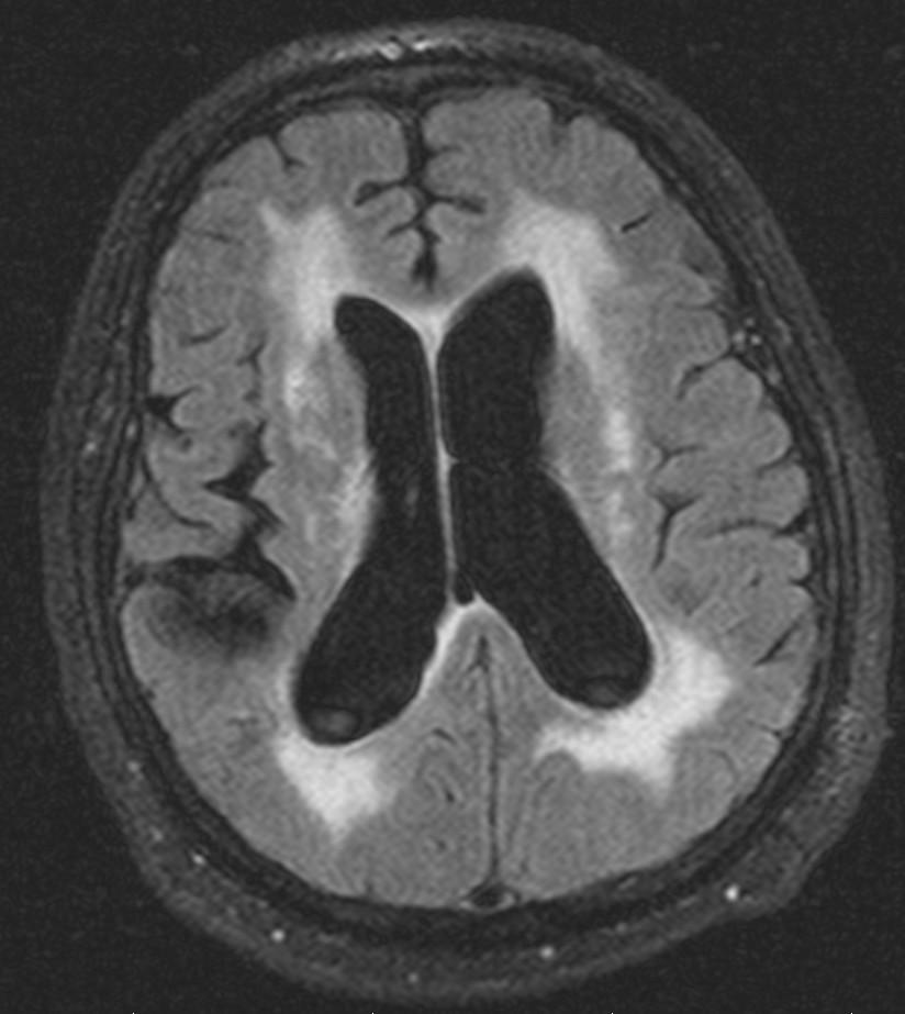 MRI T2 FLAIR (fluid-attenuated inversion recovery) Potlačení signálu vody (likvoru) proto jsou mozkové komory tmavé Identifikace