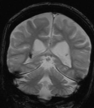 MRI GRE (tzv.