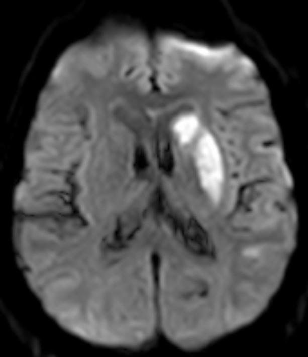 MRI DWI/ADC (diffusion weighed imaging/apparent diffusion coefficient) Zobrazuje změny signálu způsobené difúzí molekul vody Kvantitativní