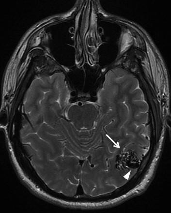 MR angiografie (TOF) a 3D rekonstrukce