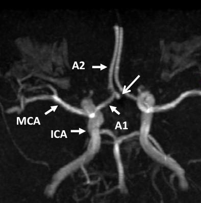 angiografie (TOF) a T2 vážený obraz zobrazující