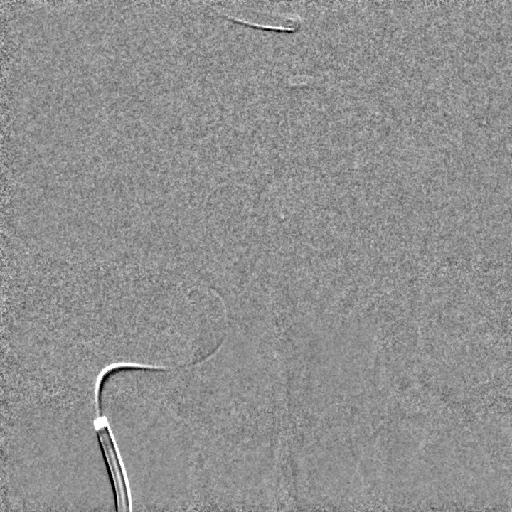 Aneurysma coiling (video) A B C C Aneurysma přední komunikanty (šipka)