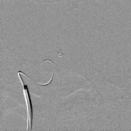 nástřik (B) v průběhu coilingu implantace spirál do vaku k vyřazení