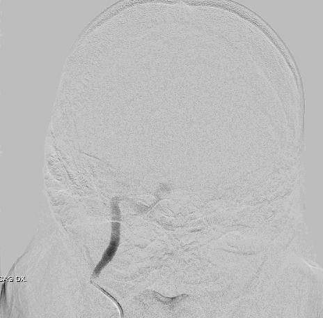 Arteriovenózní malformace (video) A B C