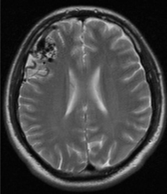 neurochirurgickém výkonu (naložení
