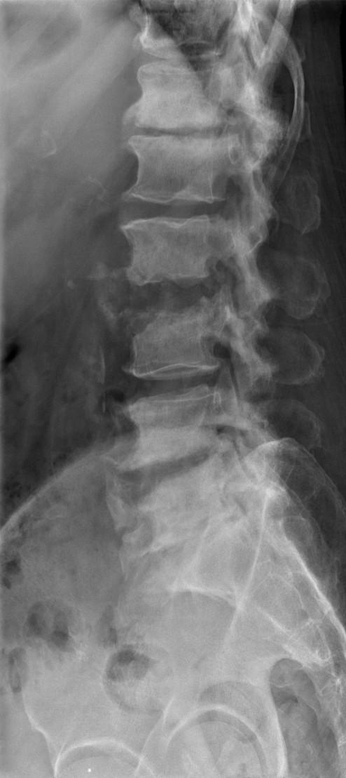 MR spondylodiscitida RTG T2 T1 T1+KL