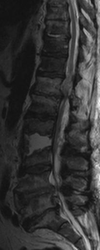 plotének (spondylodiscitida)
