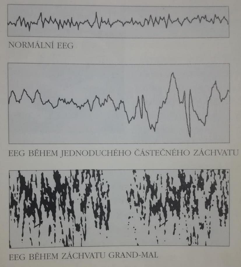 2 Elektroencefalografie (EEG) Elektroencefalografie je elektrofyziologická monitorovací metoda, která zaznamenává elektrickou aktivitu mozku. Výstupem z ní je záznam, tzv.