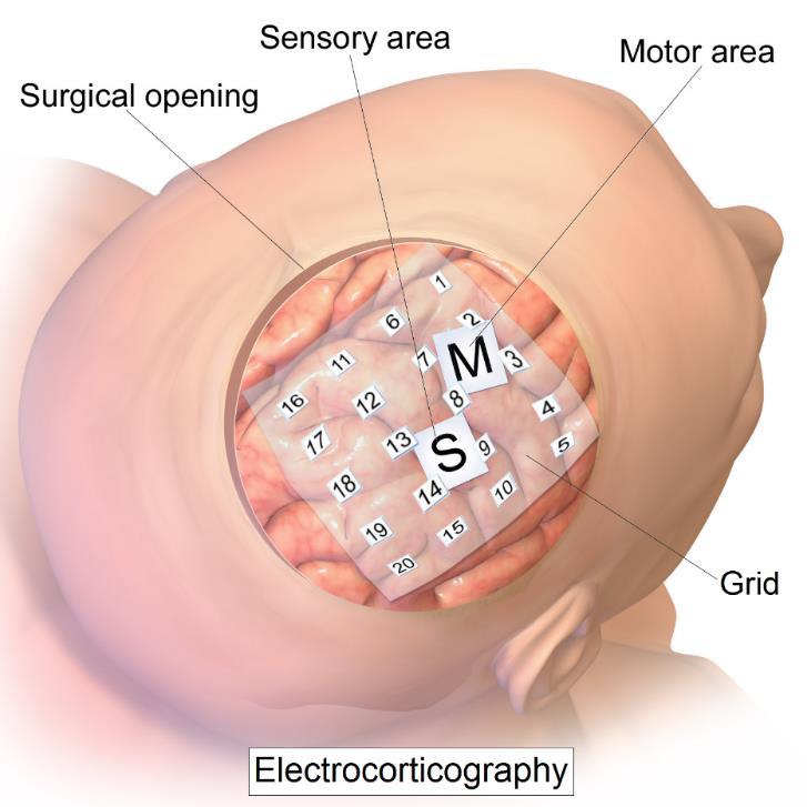 Stereoelektroencefalografie (SEEG) Obrázek 7 Elektrokortikografie [4] Zde se používají hloubkové elektrody (jehlové), které jsou vnořené do určitých mozkových struktur.