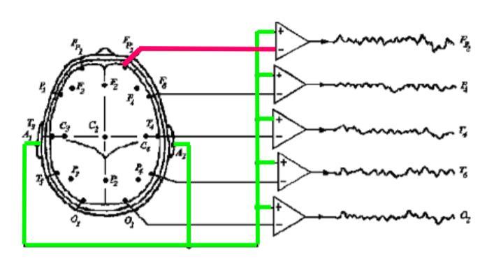 Obrázek 9 Unipolární zapojení [3] Bipolární Bipolární zapojení (Obr. 10) získáme virtuálně odečtením hodnot dvou sousedních elektrod.