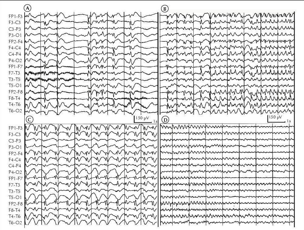Nekonvulzivní status epilepticus Zdroj: Aulický