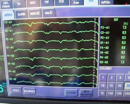 Patologické elektroencefalografy Hrot - ostrý (špičatý), doba trvání 20-80 ms Ostré vlny - pomalejší, doba trvání 80-200 ms Komplex hrot - pomalá vlna - spike waves, SW Consensus Statement on