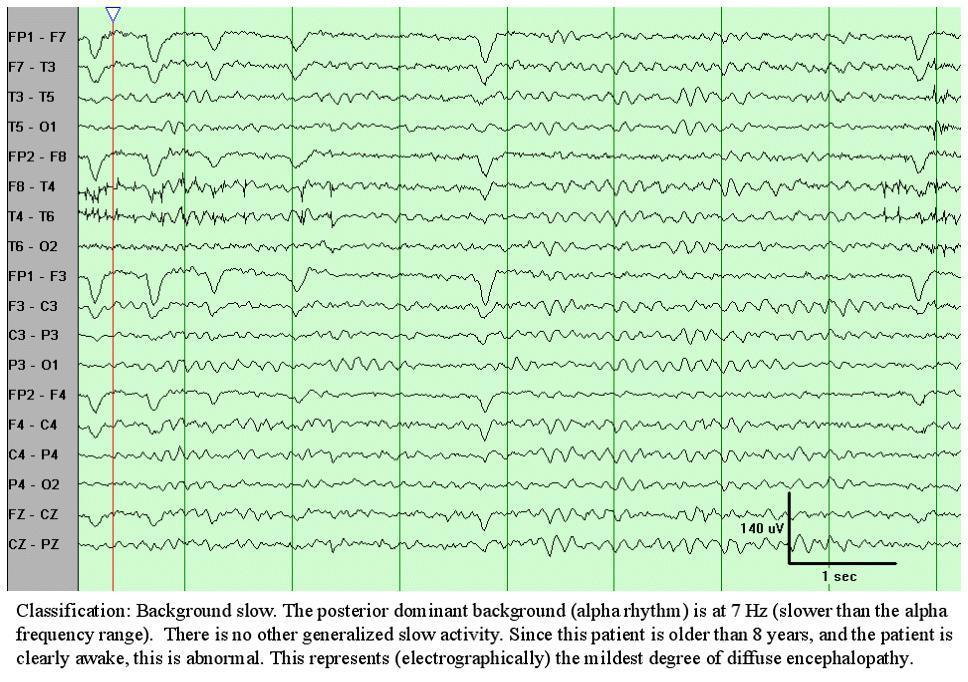 EEG u pacienta v intenzivní péči Setkáváme se obvykle se zpomalením základní biolelektrické aktivity - alfa -- theta --- delta Důvodem je vliv analgosedace