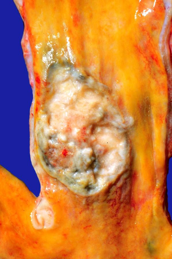 3 fundus 4 tělo 5 antrum