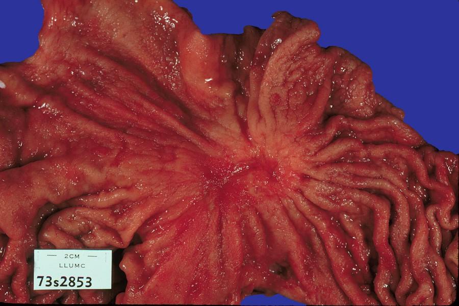 Adenokarcinom