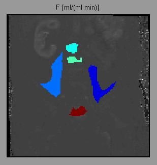 Obrázek 3.23: Srovnání map perfusního parametru pro první vyšetření prvního pacienta, škálování na plochu pod washout fází AIF (vlevo analýza Several ROIs, vpravo analýza MultiROI).